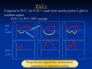 PAV+ vs. PCV /PSV example PCV 15 cmH2O PAV+ at 75% Compared to PCV, the PAV+ mode better matches patient’s effort to ventilator output. PAV+ P T P T P T P T P T P T Proportional support has synchronised  inspiration to expiration cycling 