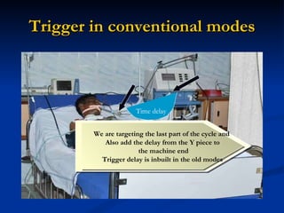 Trigger in conventional modes Time delay We are targeting the last part of the cycle and  Also add the delay from the Y piece to the machine end Trigger delay is inbuilt in the old modes 