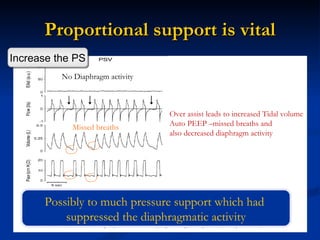 Proportional support is vital No Diaphragm activity Missed breaths Over assist leads to increased Tidal volume  Auto PEEP –missed breaths and  also decreased diaphragm activity Possibly to much pressure support which had  suppressed the diaphragmatic activity Increase the PS 
