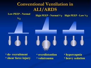 Conventional Ventilation in ALI/ARDS Low PEEP - Normal V T High PEEP - Normal  V T High PEEP - Low  V T de- recruitment shear force injury overdistention volutrauma hypercapnia heavy sedation 