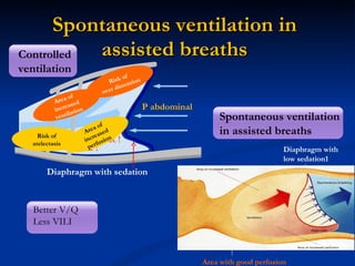 Spontaneous ventilation in assisted breaths Diaphragm with sedation P abdominal Area of  increased ventilation Area of increased perfusion Risk of  over distention Risk of atelectasis Good ventilated area Area with good perfusion R ! R ! R ! Spontaneous breathing Diaphragm with low sedation1 Spontaneous ventilation  in assisted breaths Controlled ventilation Better V/Q Less VILI R ! R ! R ! 