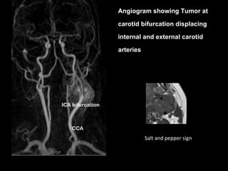 Angiogram showing Tumor at

carotid bifurcation displacing

internal and external carotid

arteries




           Salt and pepper sign
 