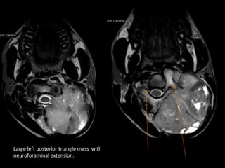 Large left posterior triangle mass with
neuroforaminal extension.
 