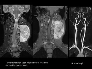Tumor extension seen within neural foramen   Normal angio
and inside spinal canal.
 