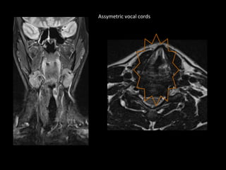 Assymetric vocal cords
 