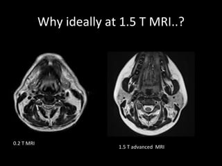 Why ideally at 1.5 T MRI..?




0.2 T MRI
                          1.5 T advanced MRI
 