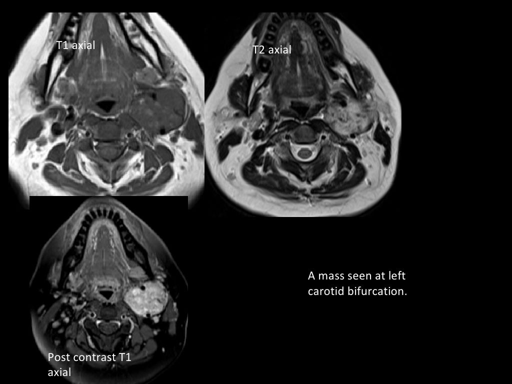 MRI in neck imaging