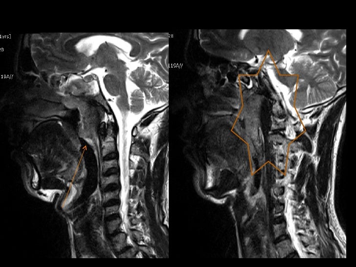 mri-in-neck-imaging