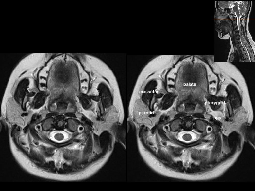 MRI in neck imaging