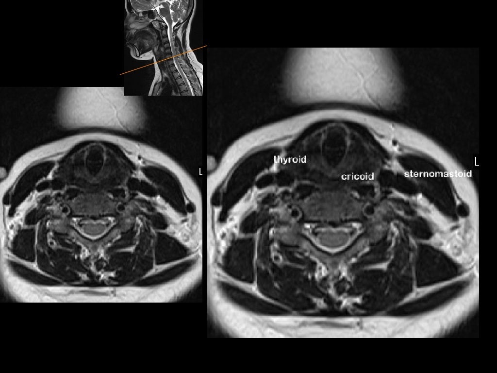 MRI in neck imaging