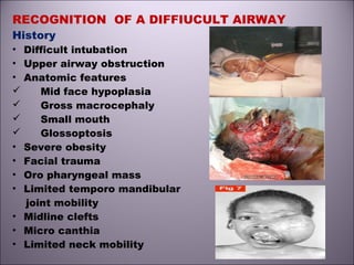RECOGNITION OF A DIFFIUCULT AIRWAY
History
• Difficult intubation
• Upper airway obstruction
• Anatomic features
 Mid face hypoplasia
 Gross macrocephaly
 Small mouth
 Glossoptosis
• Severe obesity
• Facial trauma
• Oro pharyngeal mass
• Limited temporo mandibular
joint mobility
• Midline clefts
• Micro canthia
• Limited neck mobility
 
