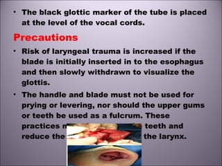 • The black glottic marker of the tube is placed
at the level of the vocal cords.
Precautions
• Risk of laryngeal trauma is increased if the
blade is initially inserted in to the esophagus
and then slowly withdrawn to visualize the
glottis.
• The handle and blade must not be used for
prying or levering, nor should the upper gums
or teeth be used as a fulcrum. These
practices may damage to the teeth and
reduce the ability to visualize the larynx.
 
