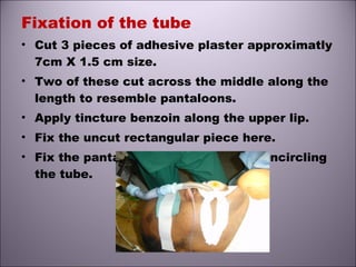 Fixation of the tube
• Cut 3 pieces of adhesive plaster approximatly
7cm X 1.5 cm size.
• Two of these cut across the middle along the
length to resemble pantaloons.
• Apply tincture benzoin along the upper lip.
• Fix the uncut rectangular piece here.
• Fix the pantaloons on both cheeks encircling
the tube.
 