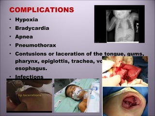 COMPLICATIONS
• Hypoxia
• Bradycardia
• Apnea
• Pneumothorax
• Contusions or laceration of the tongue, gums,
pharynx, epiglottis, trachea, vocal cords or
esophagus.
• Infections
• Post- extubation stridor
 
