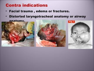 Contra indications
• Facial trauma , edema or fractures.
• Distorted laryngotracheal anatomy or airway
anatomy.
 