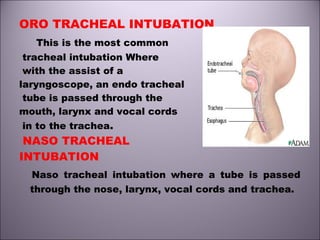 ORO TRACHEAL INTUBATION
This is the most common
tracheal intubation Where
with the assist of a
laryngoscope, an endo tracheal
tube is passed through the
mouth, larynx and vocal cords
in to the trachea.
NASO TRACHEAL
INTUBATION
Naso tracheal intubation where a tube is passed
through the nose, larynx, vocal cords and trachea.
 