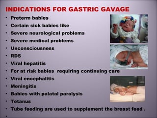 INDICATIONS FOR GASTRIC GAVAGE
• Preterm babies
• Certain sick babies like
• Severe neurological problems
• Severe medical problems
• Unconsciousness
• RDS
• Viral hepatitis
• For at risk babies requiring continuing care
• Viral encephalitis
• Meningitis
• Babies with palatal paralysis
• Tetanus
• Tube feeding are used to supplement the breast feed .
•
 