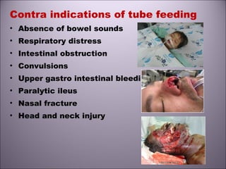 Contra indications of tube feeding
• Absence of bowel sounds
• Respiratory distress
• Intestinal obstruction
• Convulsions
• Upper gastro intestinal bleeding
• Paralytic ileus
• Nasal fracture
• Head and neck injury
 