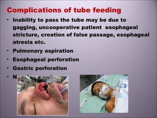 Complications of tube feeding
• Inability to pass the tube may be due to
gagging, uncooperative patient esophageal
stricture, creation of false passage, esophageal
atresia etc.
• Pulmonary aspiration
• Esophageal perforation
• Gastric perforation
• Nasal necrosis
 