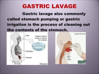 GASTRIC LAVAGE
Gastric lavage also commonly
called stomach pumping or gastric
irrigation is the process of cleaning out
the contents of the stomach.
 