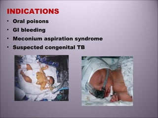 INDICATIONS
• Oral poisons
• GI bleeding
• Meconium aspiration syndrome
• Suspected congenital TB
 