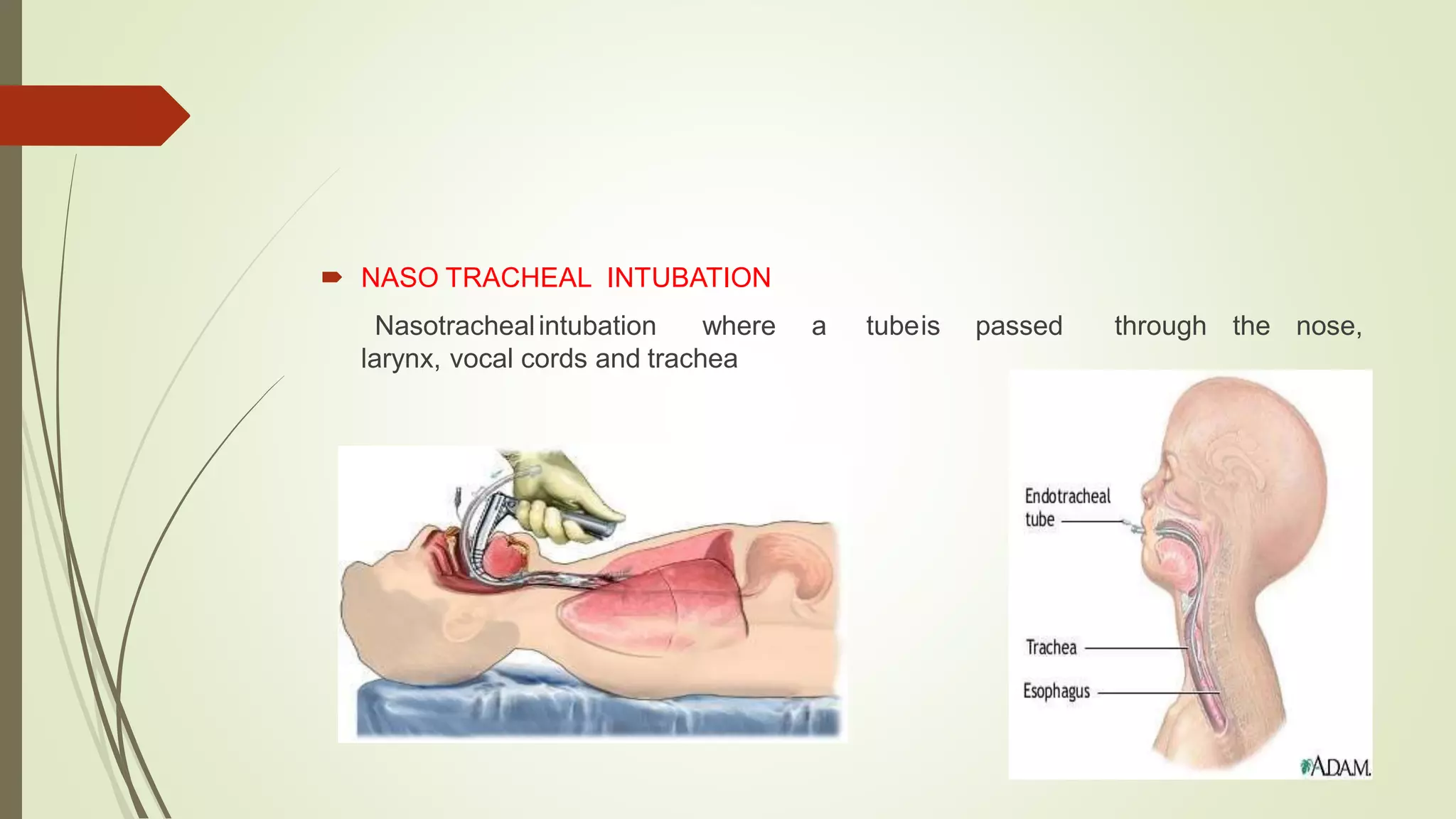  NASO TRACHEAL INTUBATION
Nasotrachealintubation where a tubeis passed through the nose,
larynx, vocal cords and trachea
 