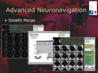 Advanced Neuronavigation
•  Stealth Merge
 