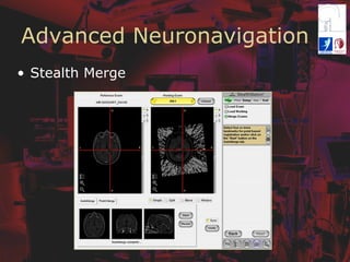 Advanced Neuronavigation
•  Stealth Merge
 