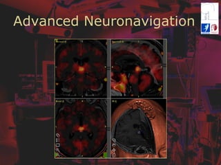 Advanced Neuronavigation
 
