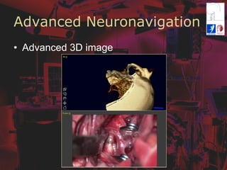 Advanced Neuronavigation
•  Advanced 3D image
 