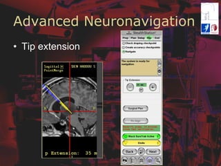 Advanced Neuronavigation
•  Tip extension
 