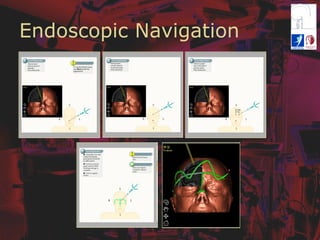 Endoscopic Navigation
 