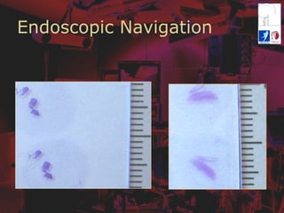 Endoscopic Navigation
 