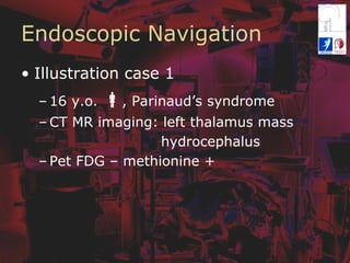 Endoscopic Navigation
•  Illustration case 1
– 16 y.o. !, Parinaud’s syndrome
– CT MR imaging: left thalamus mass
hydrocephalus
– Pet FDG – methionine +
 
