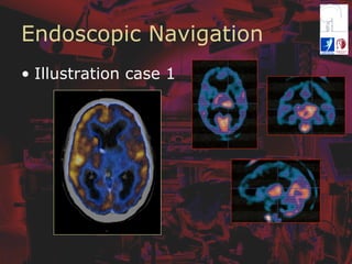 Endoscopic Navigation
•  Illustration case 1
 