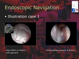 Endoscopic Navigation
•  Illustration case 1
Mass effect on Monro f.
Left approach
Hydrocephalus aspect of Monro f.
 