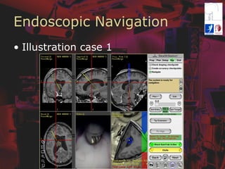 Endoscopic Navigation
•  Illustration case 1
 