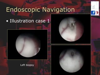 Endoscopic Navigation
•  Illustration case 1
Left biopsy
 