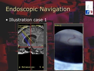 Endoscopic Navigation
•  Illustration case 1
 