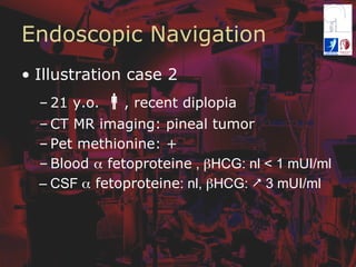 Endoscopic Navigation
•  Illustration case 2
– 21 y.o. ", recent diplopia
– CT MR imaging: pineal tumor
– Pet methionine: +
– Blood α fetoproteine , βHCG: nl < 1 mUI/ml
– CSF α fetoproteine: nl, βHCG: & 3 mUI/ml
 