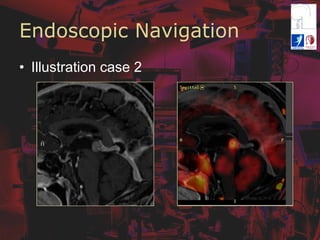 Endoscopic Navigation
•  Illustration case 2
 