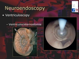 Neuroendoscopy
•  Ventriculoscopy
–  Ventriculocisternostomie
 