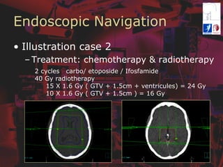 Endoscopic Navigation
•  Illustration case 2
– Treatment: chemotherapy & radiotherapy
2 cycles carbo/ etoposide / Ifosfamide
40 Gy radiotherapy
15 X 1.6 Gy ( GTV + 1.5cm + ventricules) = 24 Gy
10 X 1.6 Gy ( GTV + 1.5cm ) = 16 Gy
 