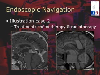 Endoscopic Navigation
•  Illustration case 2
– Treatment: chémothérapy & radiotherapy
 