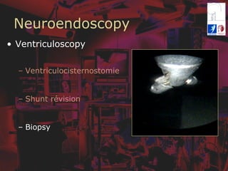 Neuroendoscopy
•  Ventriculoscopy
–  Ventriculocisternostomie
–  Shunt révision
–  Biopsy
 