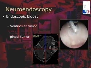 Neuroendoscopy
•  Endoscopic biopsy
–  Ventricular tumor
pineal tumor
 
