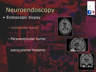 Neuroendoscopy
•  Endoscopic biopsy
–  Ventricular tumor
–  Paraventricular tumor
astrocytoma thalamic
 