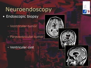Neuroendoscopy
•  Endoscopic biopsy
–  Ventricular tumor
–  Paraventricular tumor
–  Ventricular cyst
 