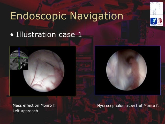 endoscopy after effects endoscopy after effects