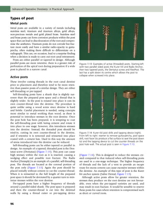 Pre Tapped Posts Advanced operative dentistry | PDF